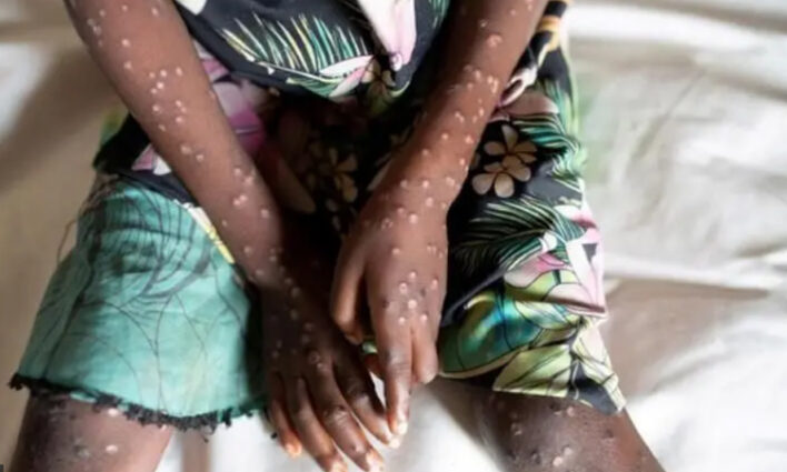 থাইল্যান্ডে এশিয়ায় প্রথম এমপক্সের নতুন প্রাণঘাতী ধরন শনাক্ত