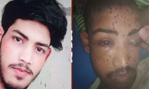 মেরুদণ্ডে বুলেট, চোখের ভেতরে গুলি আর পা হারানো তামিমের গল্প