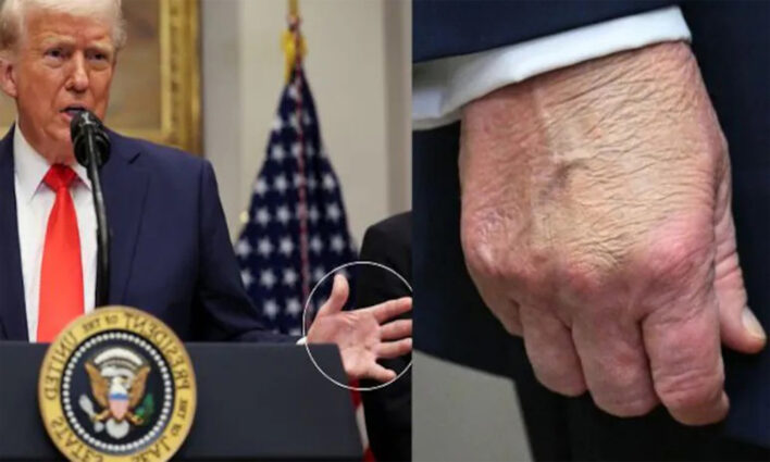 যুক্তরাষ্ট্রের প্রেসিডেন্ট ট্রাম্পের হাতে কালশিটে দাগ, জটিল রোগে আক্রান্ত তিনি?