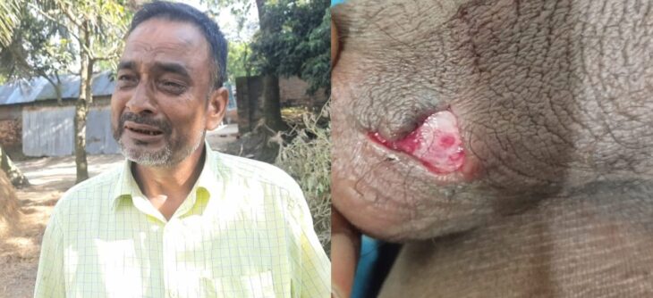 বোচাগঞ্জে নিলা রানী কর্তৃক নির্যাতনের শিকার সাবেক ইউপি সদস্য বাবুল